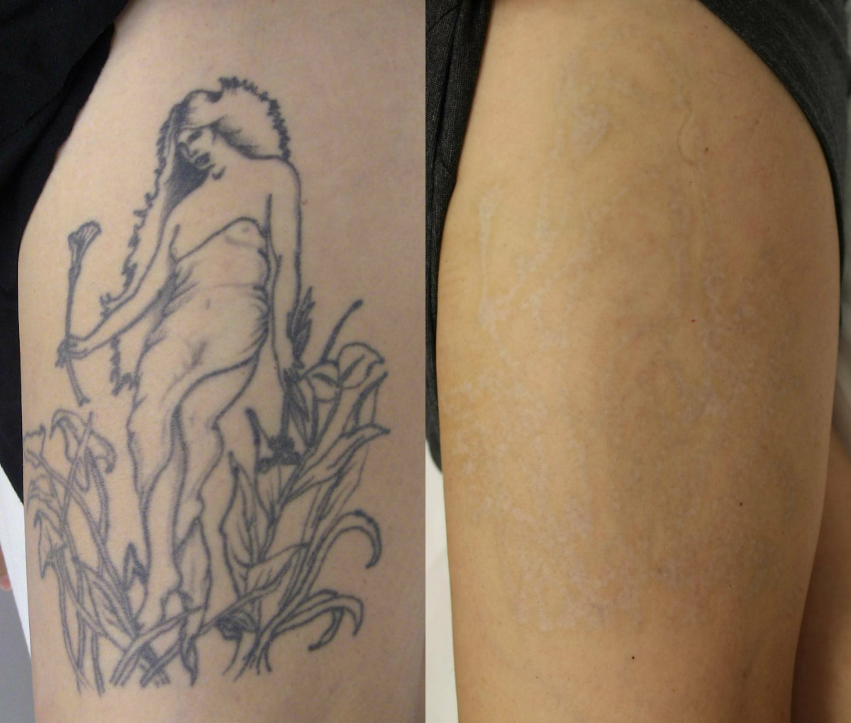 Natural Tattoo Removal: May 2013
