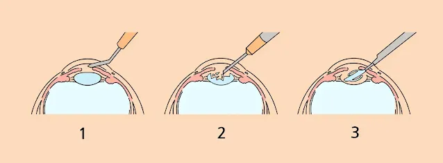 백내장 수술 단계