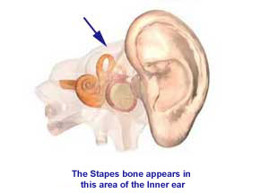 Nursing Care Plan for Otosclerosis (Postoperative)