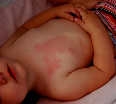 heat rash pictures in toddlers. heat rash pictures in babies.