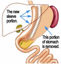  How Gastric Sleeve Surgery Works