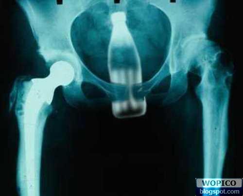 Coca cola Xray