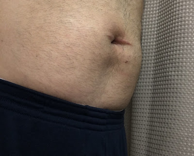 Four weeks after hernia repair at Shouldice  - right angle