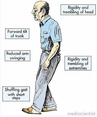 Parkinson's disease symptoms