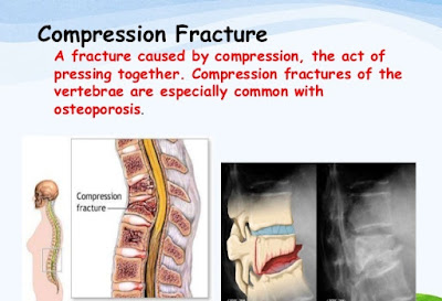 fracture type,complication of fracture,first aid fracture,surgery for fracture