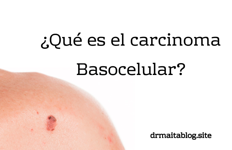 Carcinoma basocelular