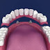 4 Benefits of Full Mouth Dental Implants