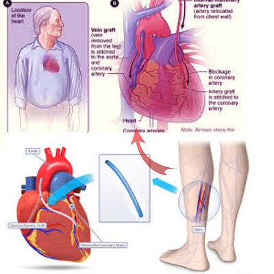 What is Coronary artery bypass surgery .?