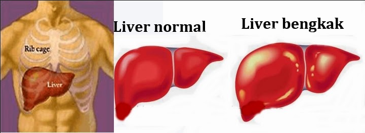 Penyakit Liver