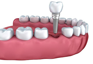 Cấu tạo của răng implant -2