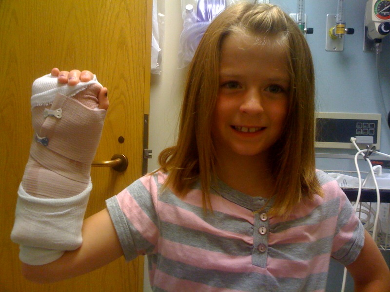 broken arm. temporary arm cast