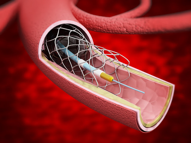 Peripheral Vascular Devices