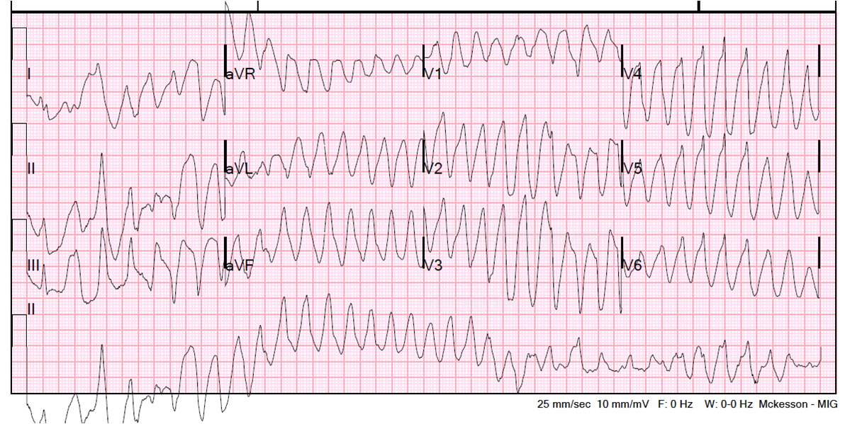 Dr. Smith's ECG Blog: Polymorphic Ventricular Tachycardia