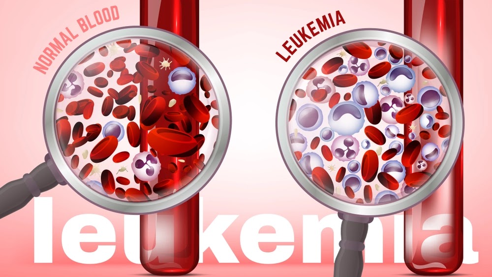 Leukemia