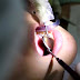 Dentist Opens Up Patient’s Mouth To Find Live Maggots Inside Her Teeth