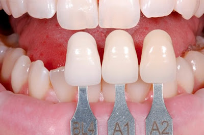 Thông tin về răng sứ không kim loại