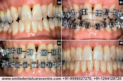 Best Invisible Aligner Treatment in Faridabad