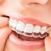 Niềng răng invisalign có tính thẩm mỹ cao