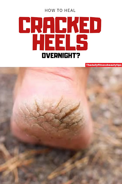 cracked-Heels-natural-treatment