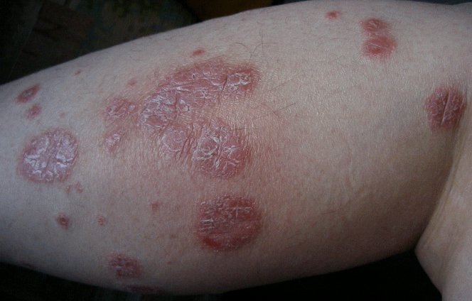 HaTi yG BeRbIcArA: Apakah itu psoriasis?