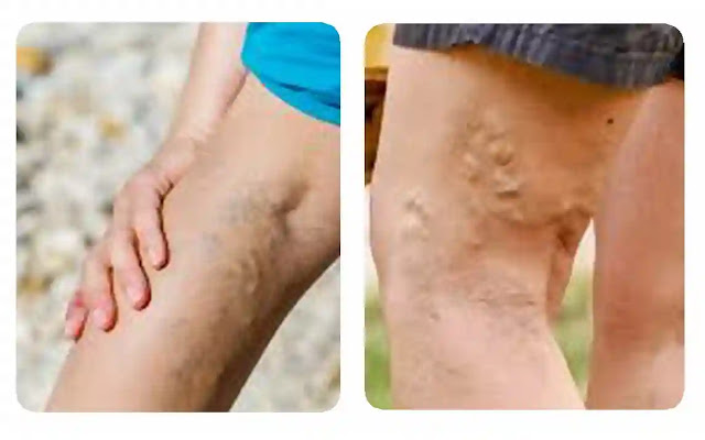 Riding the Wave of Progress Exploring New and Emerging Treatments for Varicose Veins