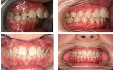 Các trường hợp răng hô phổ biến