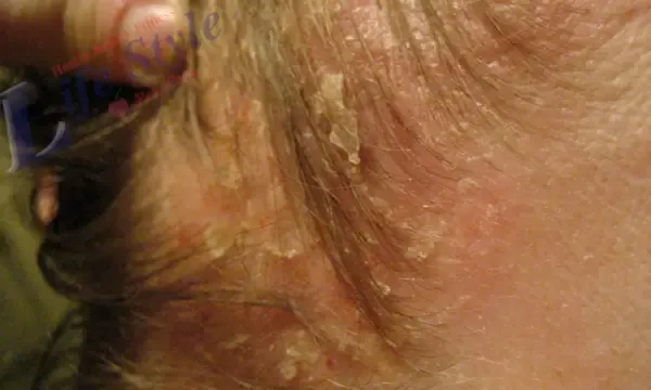 Hair diseases, seborrheic dermatitis causes, symptoms, and treatment