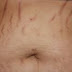 Stretch marks- A spot in the beauty of pregnant woman