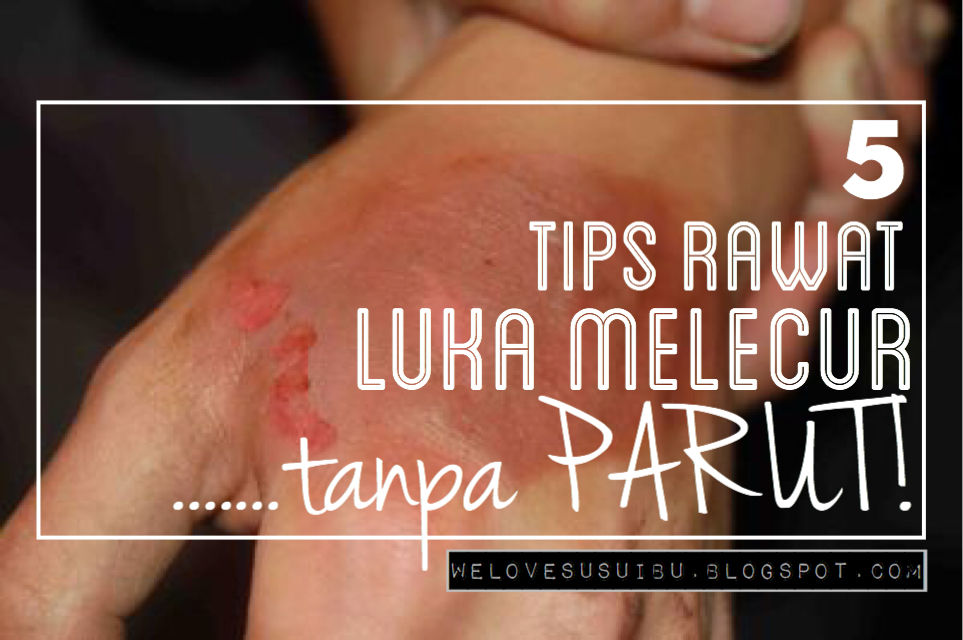 5 Tips Rawat Luka Melecur Cepat Sembuh Tanpa Parut Jelas 