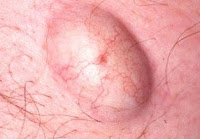 Epidermal Cyst (Epidermal Cysts) treatment and prevention