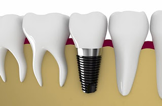 cấy ghép răng implant có đau không