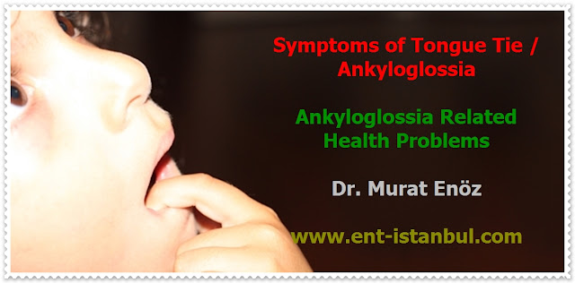 Tongue Tie (Ankyloglossia) Definition - Symptoms of Tongue Tie - Ankyloglossia Related Health Problems - Diagnosis of Tongue Tie - Treatment of Tongue Tie - Tongue Tie Surgery - Frenectomy - Frenulectomy - Frenotomy - Frenuloplasty - Post-operative Exercises for Tongue Tie Surgery - Post-Operative Instructions for Tongue Tie Surgery - Bloodless Tongue Tie Operation