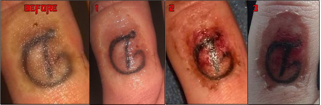 Natural Tattoo Removal: Chemical Peels Tattoo Removal - Before &amp; After