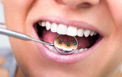 Lingual Braces in Mulund East