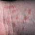 How To Get Rid of Scabies Properly