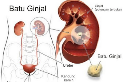 Image result for gangguan pada sistem ekskresi manusia dan upaya untuk mencegahnya