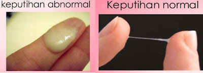 Cara Mengobati Keputihan Abnormal Dengan Cepat