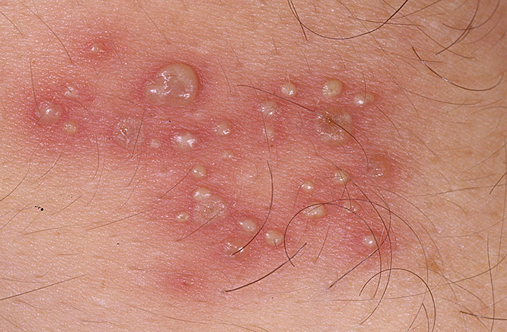 cara menyembuhkan herpes