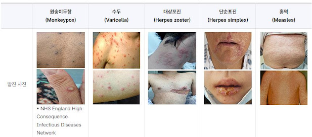 원숭이두창(엠폭스) 알아야 할 증상, 원인, 감염 경로 및 예방 방법