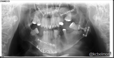 osteossintese