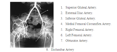 Contoh hasil gambaran ArteriografiFemoralis