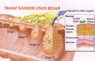 Kanker Usus