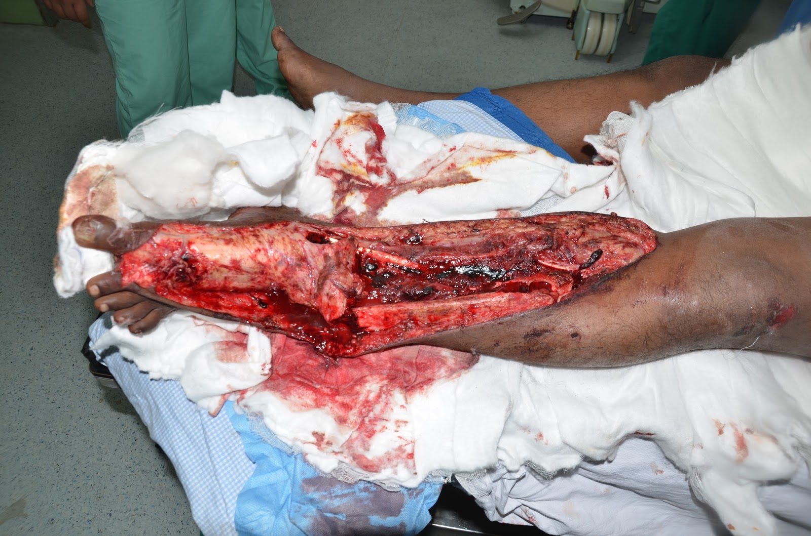 CRUSH INJURY FOOT, LOWER LIMB INJURIES AND LIMB SALVAGE: MAJOR CRUSH INJURY  LEFT LEG WITH SEGMENTAL FRACTURE TIBIA WITH ANKLE DISLOCATION - SALVAGE OF  FAILED CROSS LEG FLAP