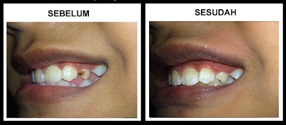 Cara Memperbaiki Gigi Berlubang Di Bagian Depan