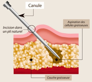 liposuccion