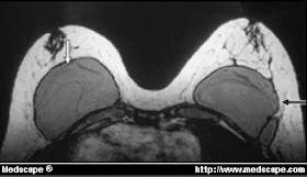 silicone breast implant rupture MRI linguine sign