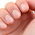 Spatulate Fingers Definition, Symptoms, Causes, Palmistry, Treatment