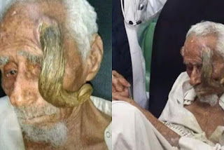 Homem que teria 140 anos morre após cirurgia para retirar 'chifres'