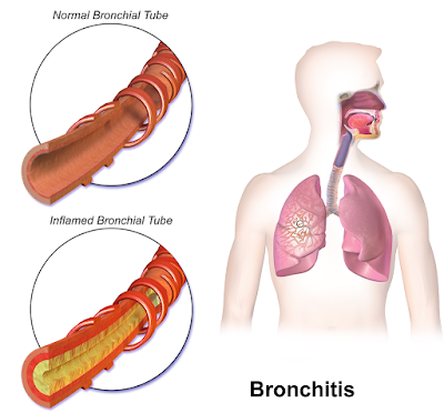 Popular Essential Oils for Bronchitis