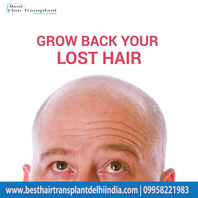 hair surgery, hair transplant, scalp reduction, hair loss, best hair surgeon, hair surgery cost, best hair clinic delhi